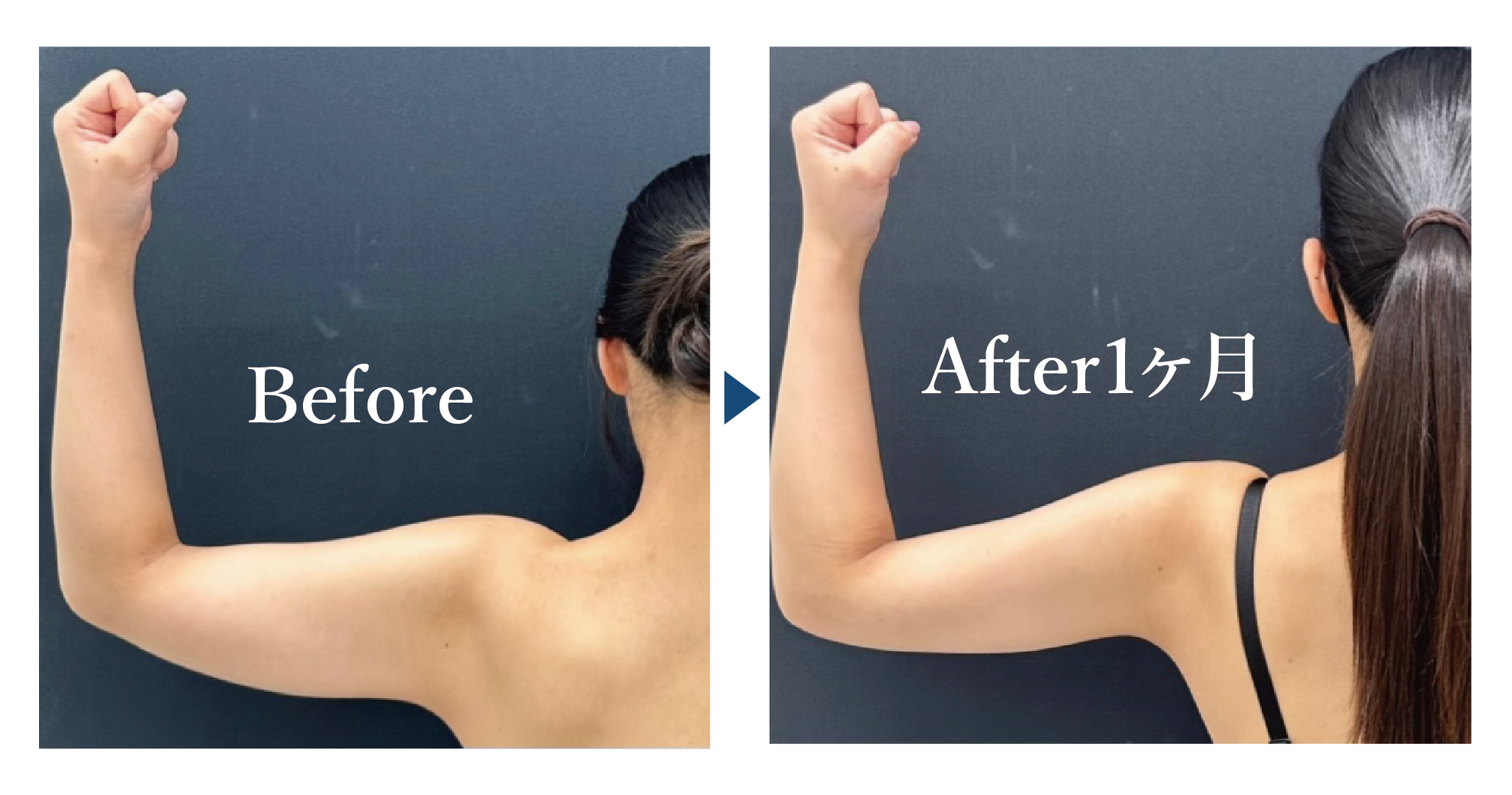 ベイザー併用アキーセル脂肪吸引（二の腕全周＋肩＋肩甲骨横＋副乳脂肪吸引注射）