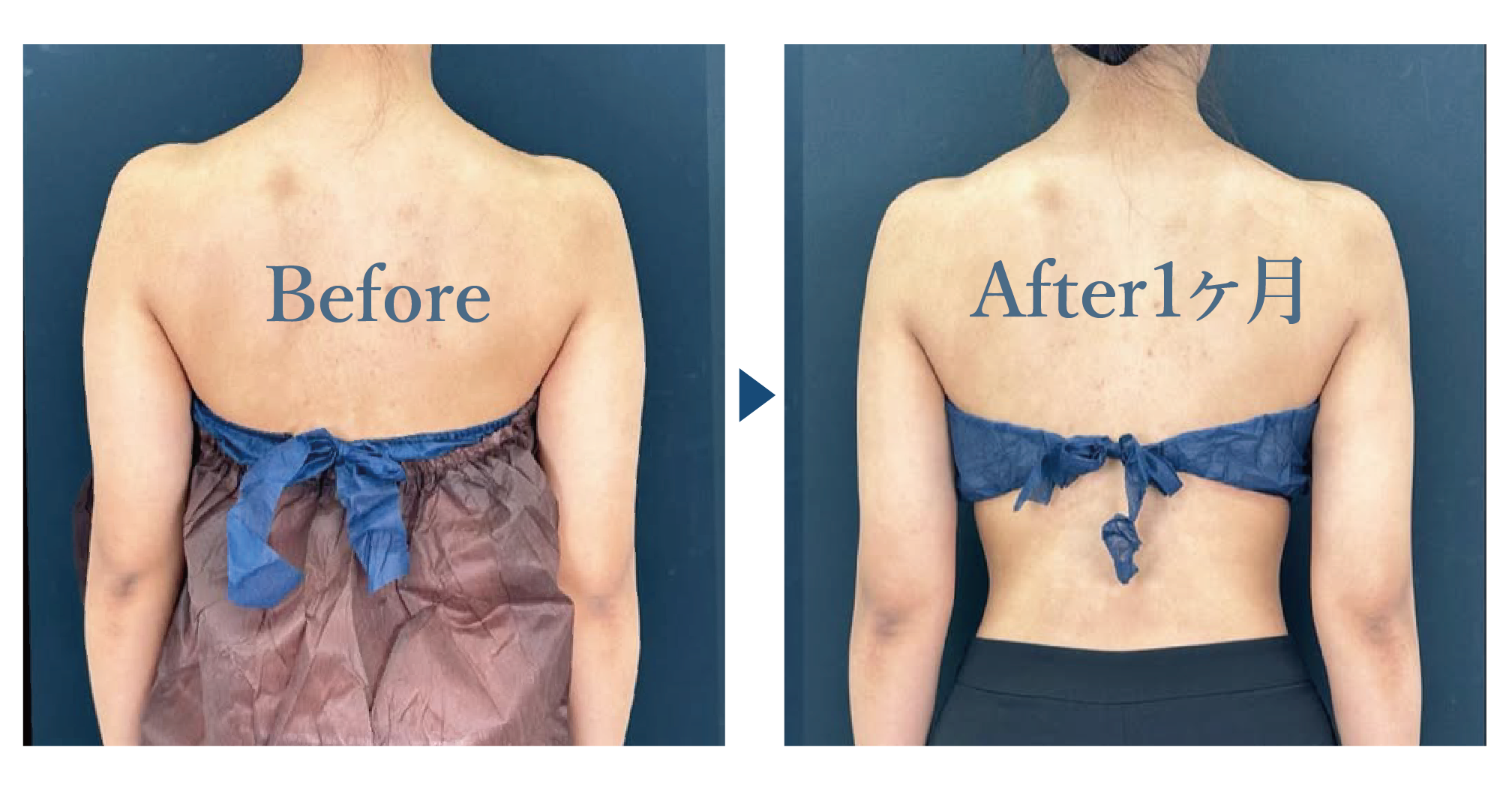 ベイザー脂肪吸引（二の腕＋肩）