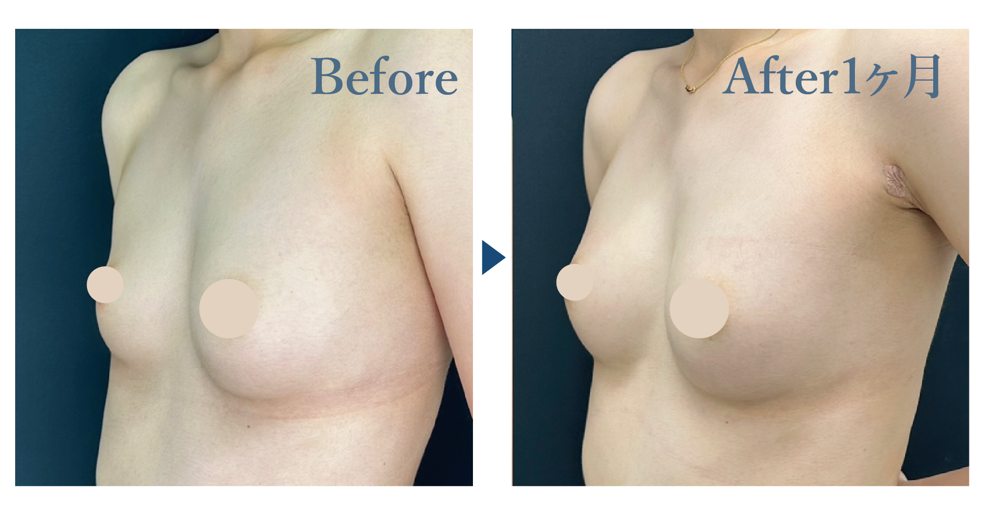 週末豊胸 -ピュアグラフト-（脂肪注入豊胸）