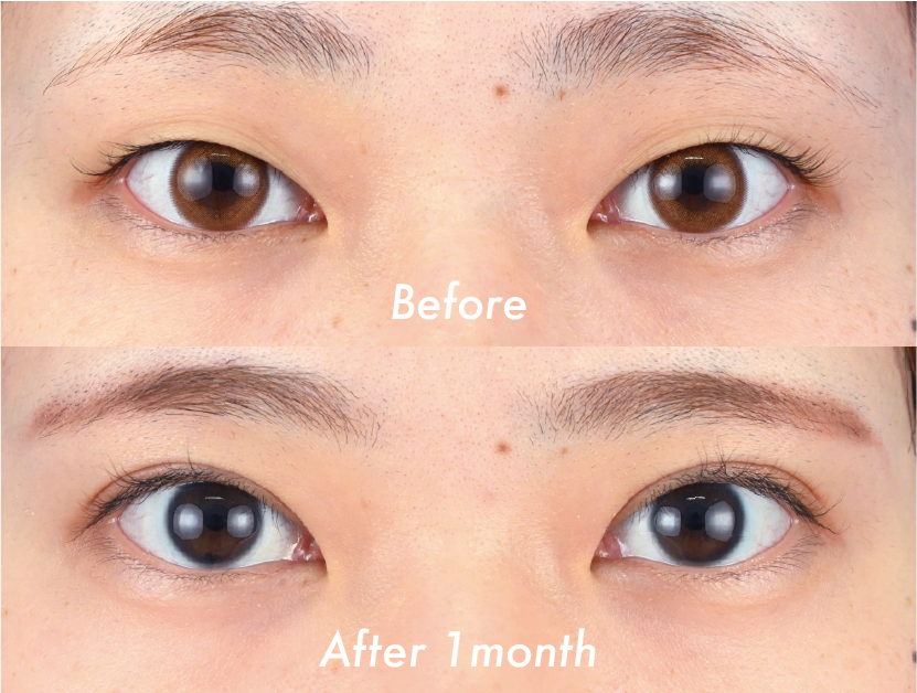 クイックコスメティーク・トリプル＋まぶたの脂肪取り（自然癒着セット）