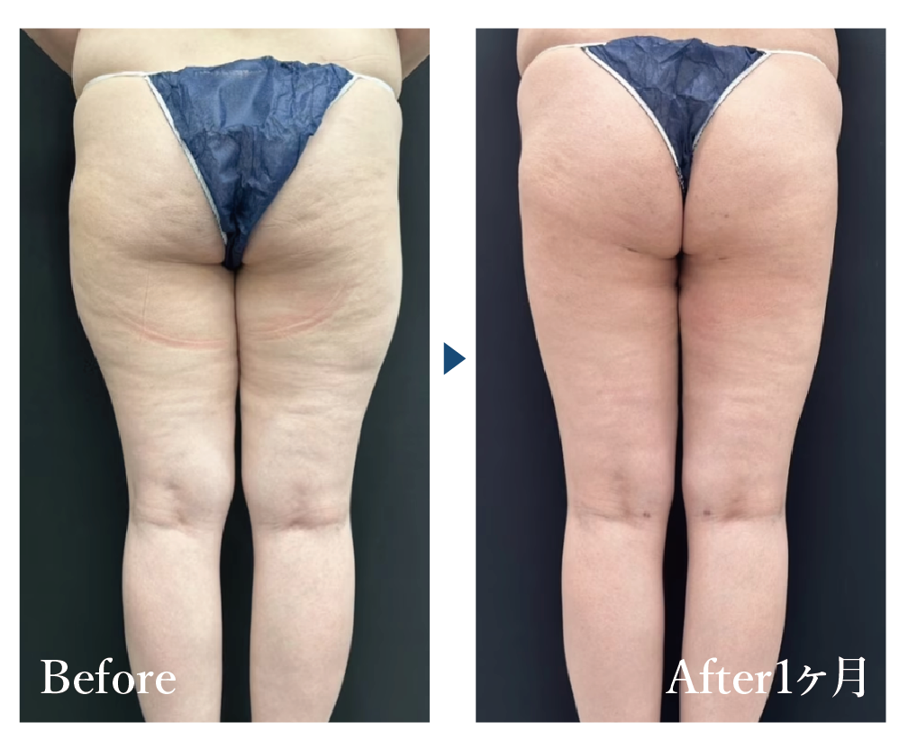 美ボディ脂肪吸引【大腿＋臀部＋お尻の脂肪吸引】