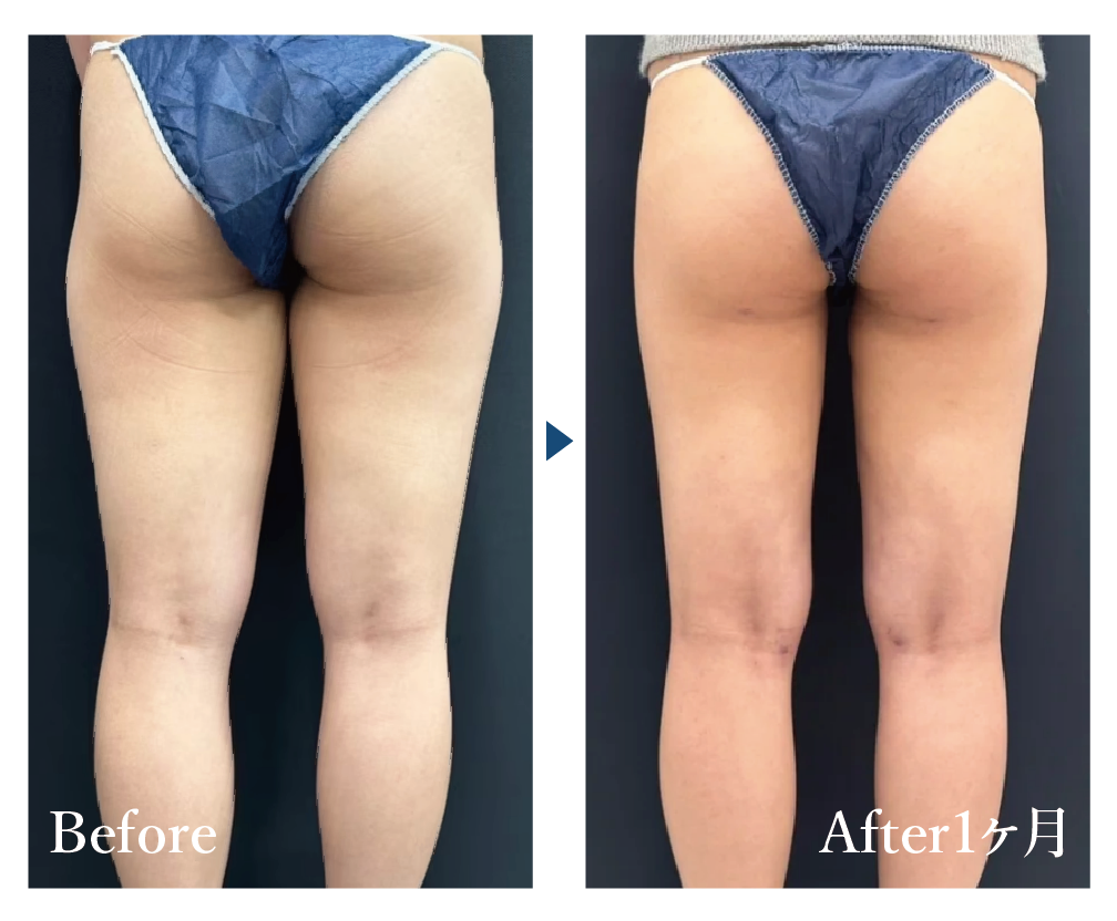 美ボディ脂肪吸引【大腿＋臀部＋お尻の脂肪吸引】