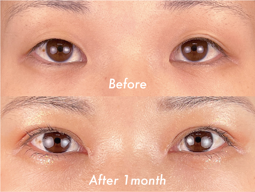 クイックコスメティーク・ダブル＋目頭切開プレミアム