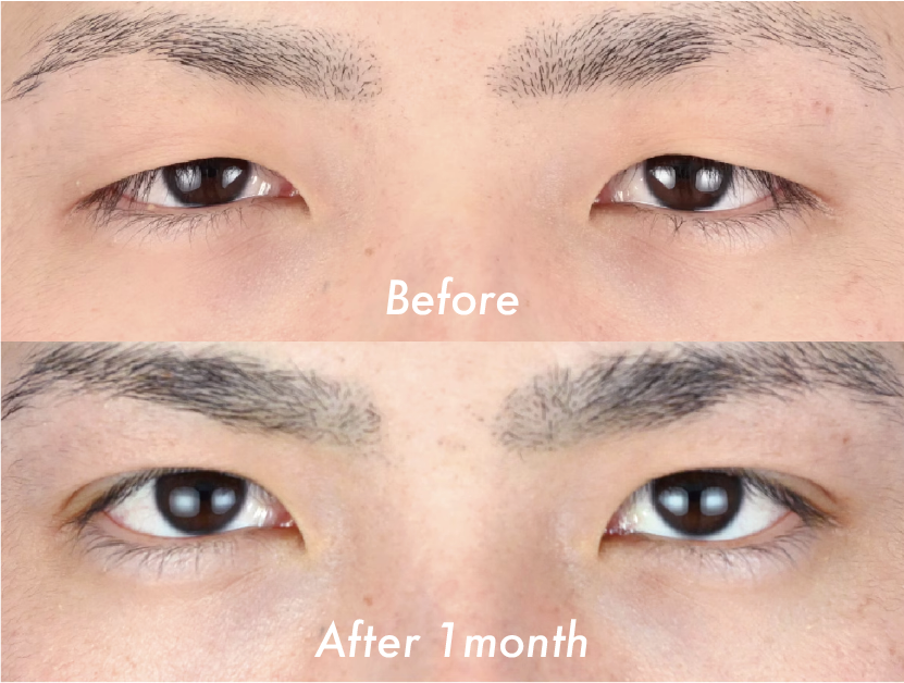 【20代男性】クイックコスメティーク・トリプルNeo