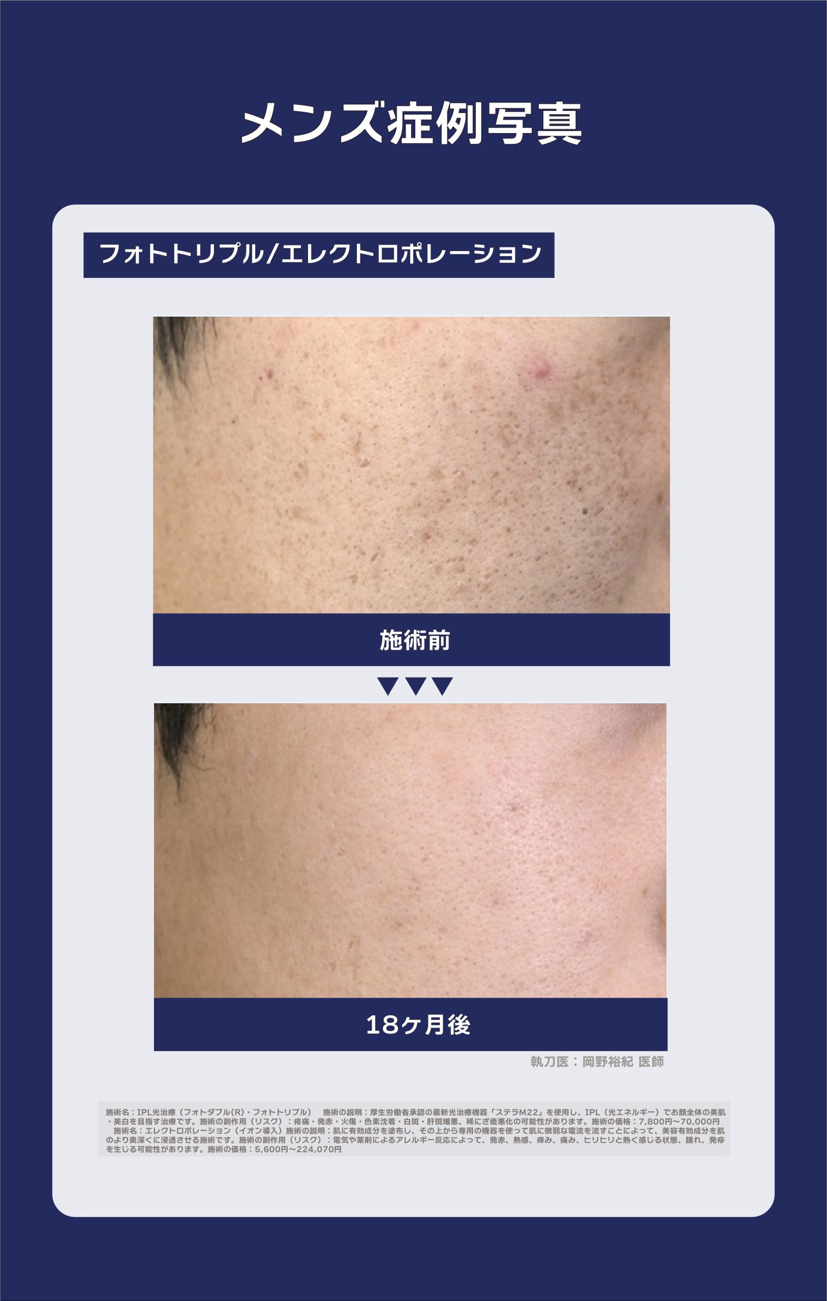 IPL光治療の症例写真