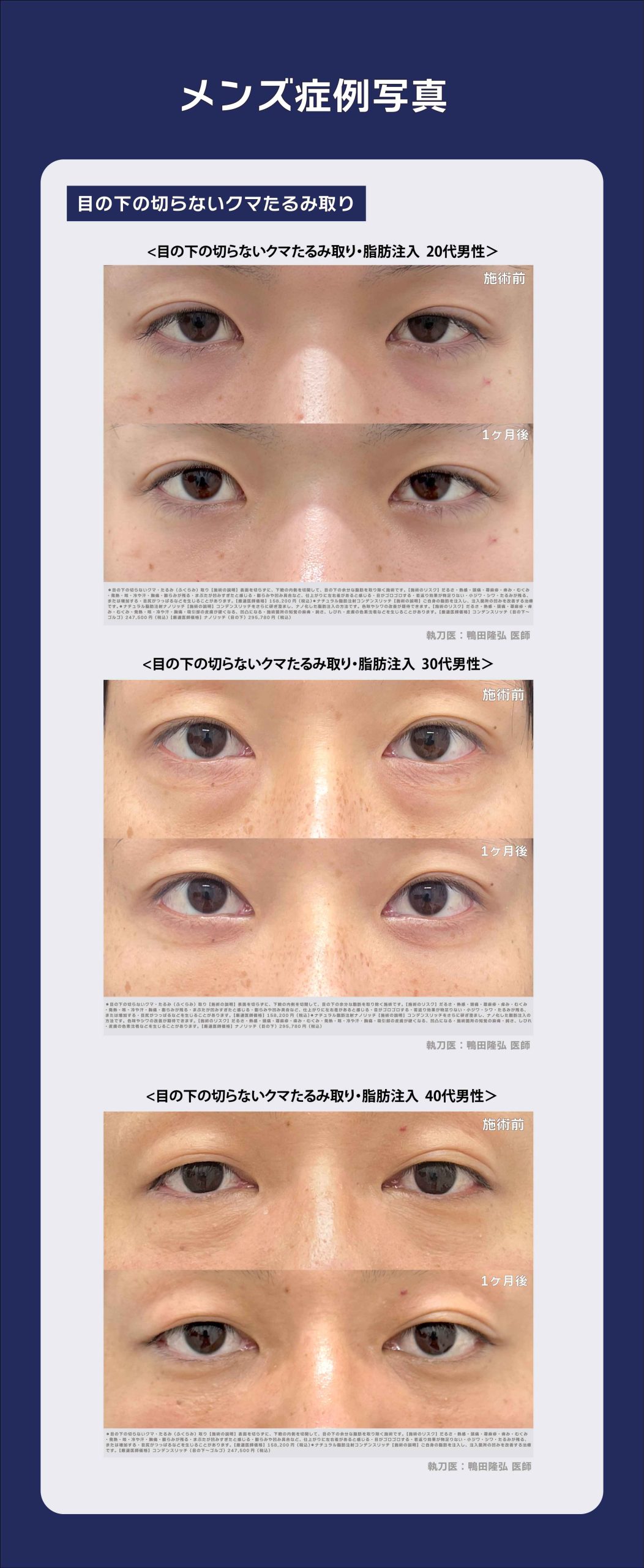 切らない目の下のクマ・ふくらみ取りの症例写真