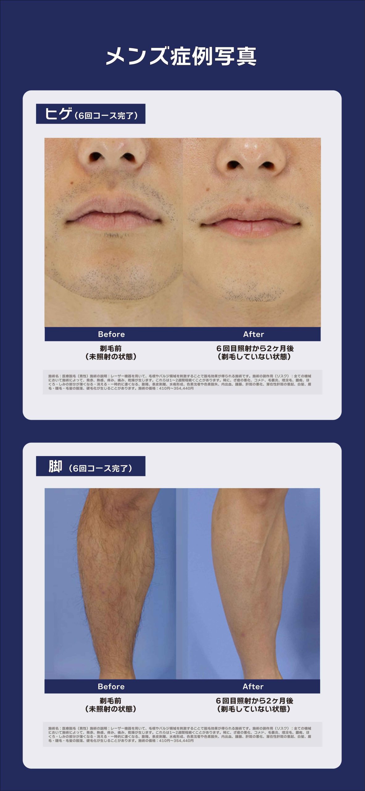 医療脱毛の症例写真