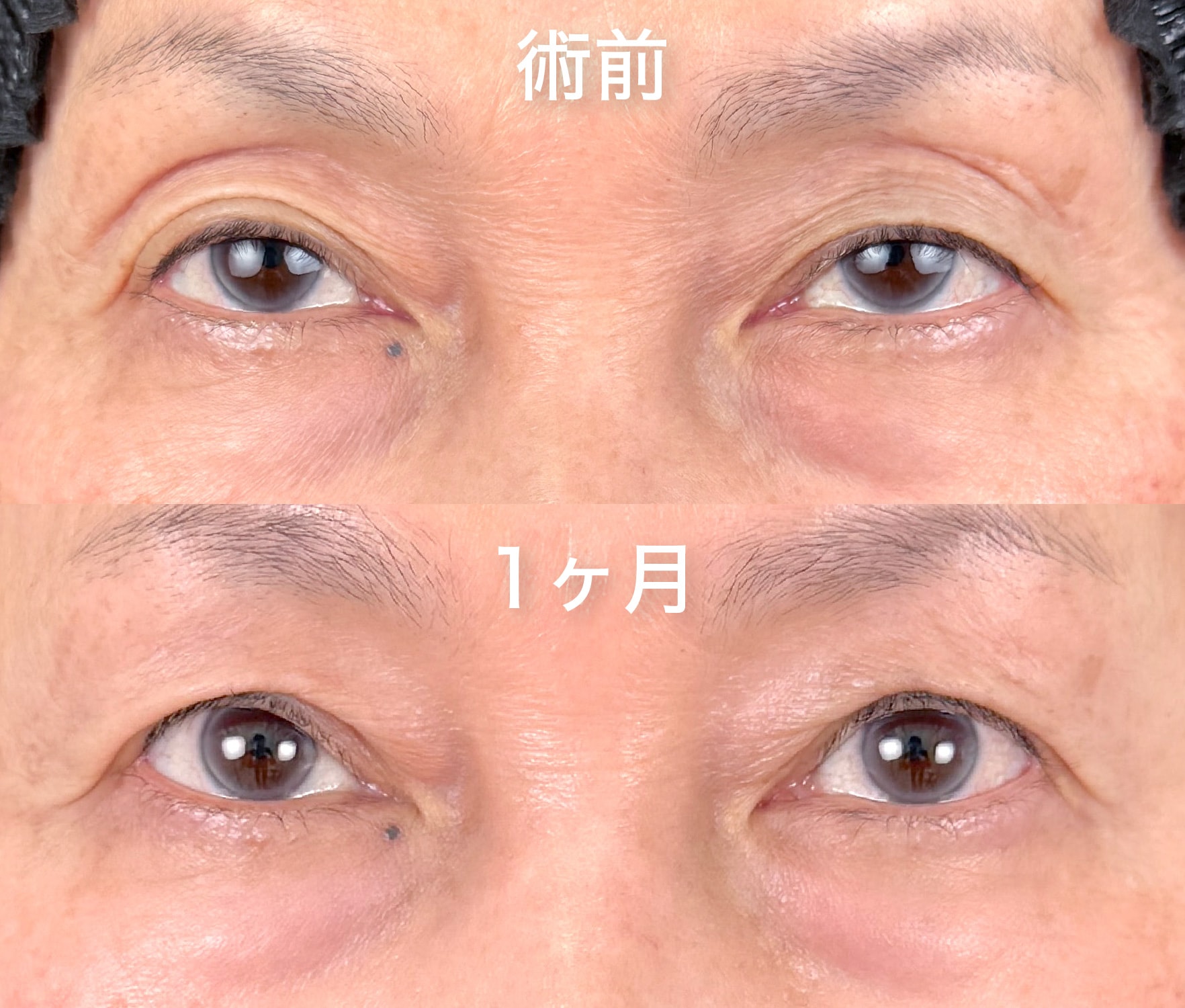 切らない眼瞼下垂 真崎式 1ヶ月後