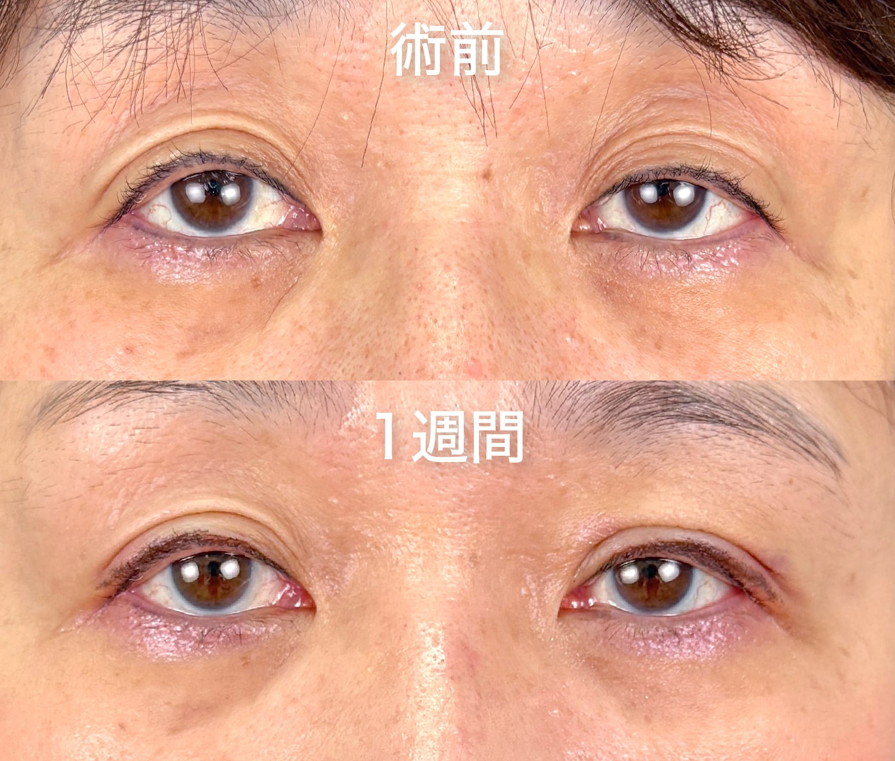 切らない眼瞼下垂 真崎式 1週間後
