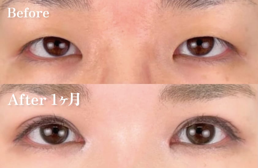 全切開二重術＋目頭切開【30代】