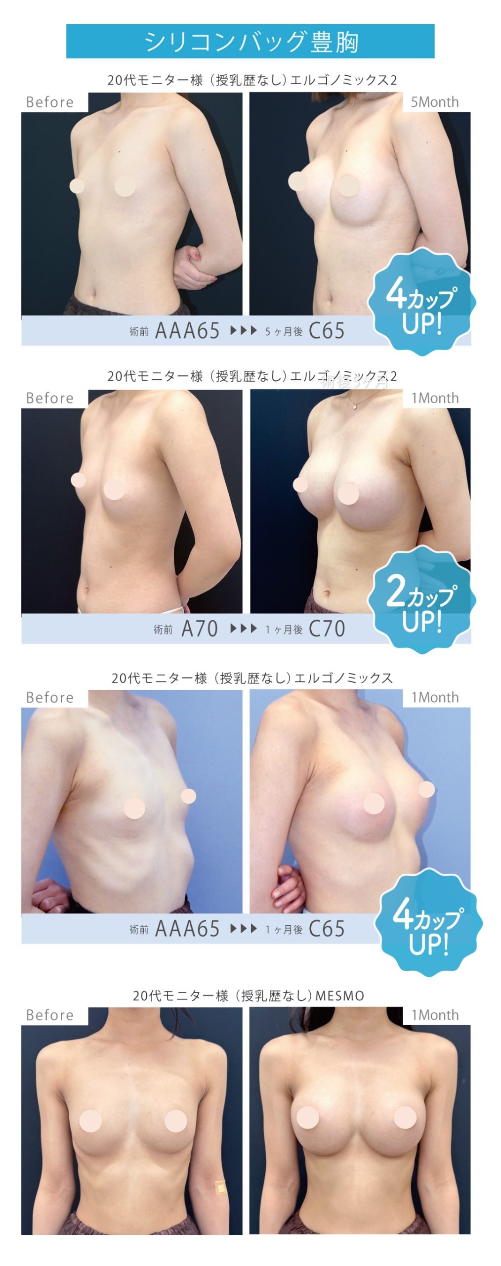 確実なバストアップ！シリコンバッグ豊胸