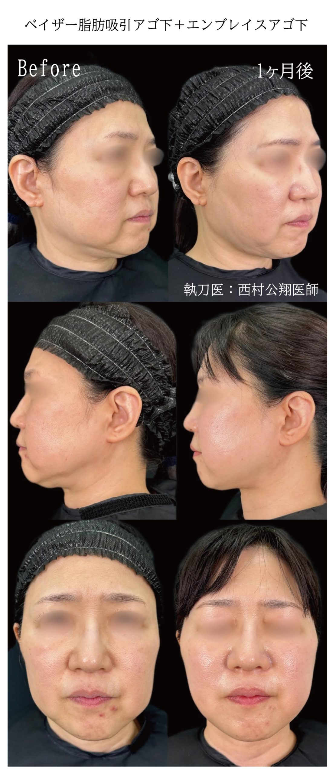 【福岡院】西村医師の症例（あご下）脂肪吸引と併用