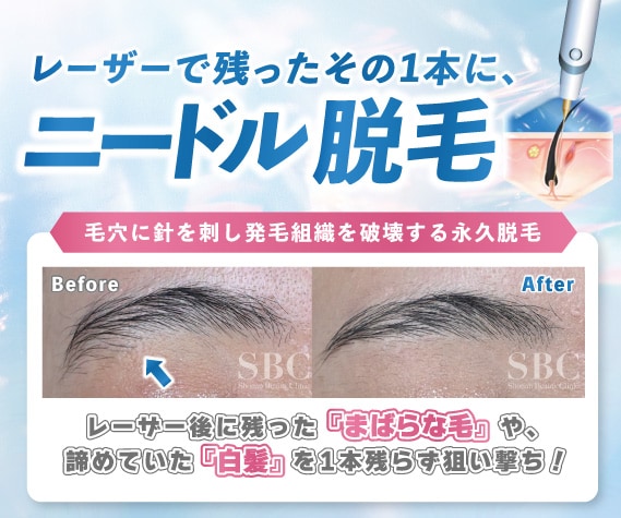【福岡・天神】ニードル脱毛(針脱毛)で白髪・眉周りの硬毛などを確実に処理！湘南美容クリニック福岡院がおすすめ