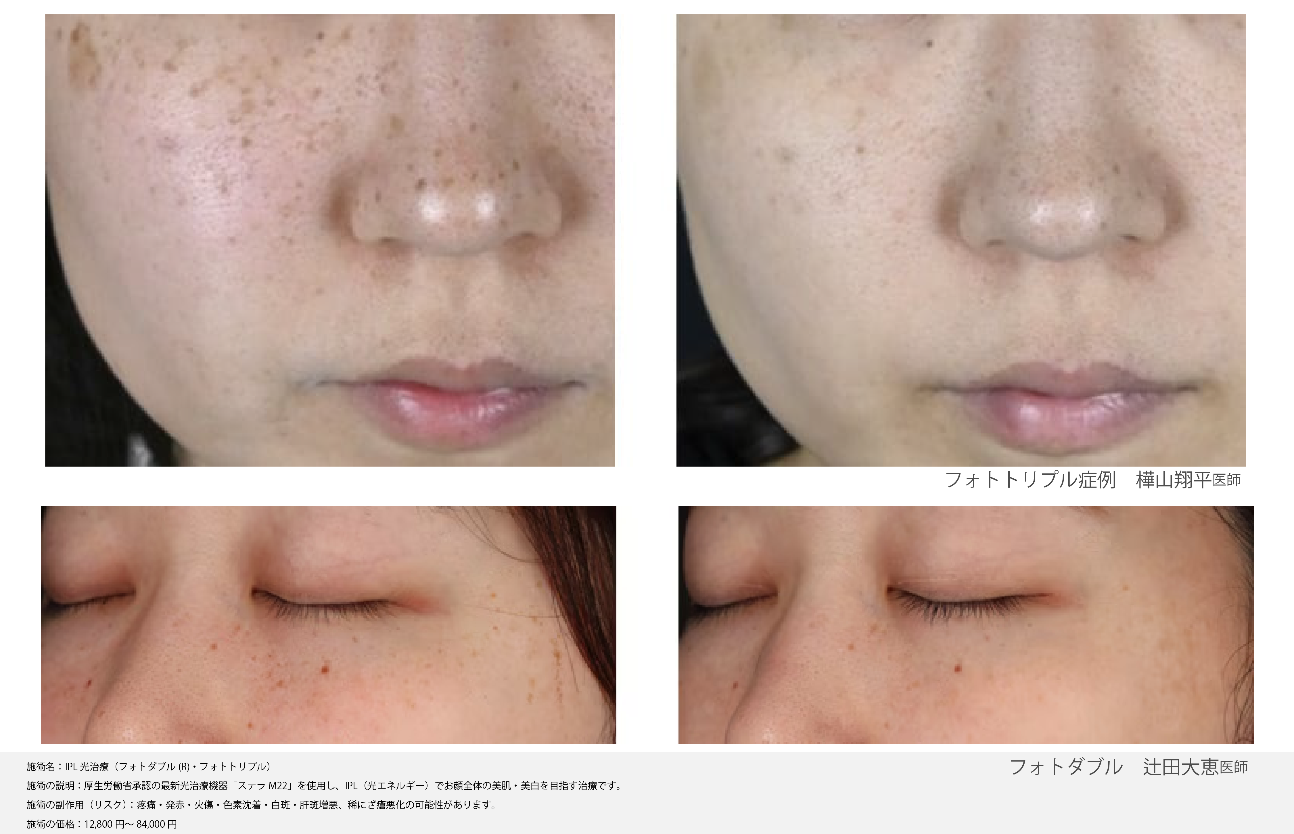 ニキビ】【そばかす】【肌育】ステラM22で美肌GET！【福島院のオススメ 