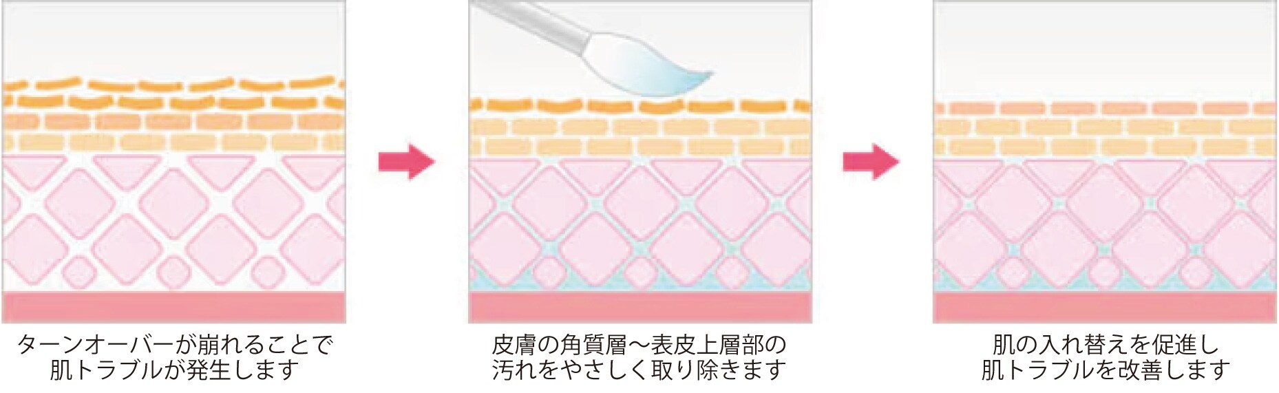 ケミカルピーリングの仕組み
