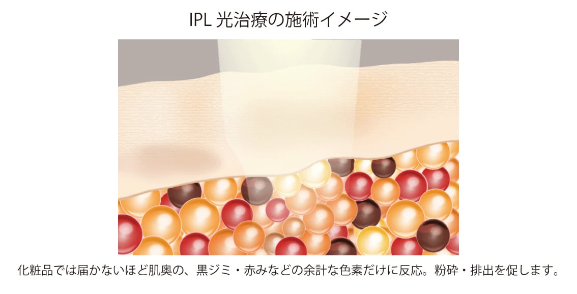 そばかすなどの薄く細かいシミに