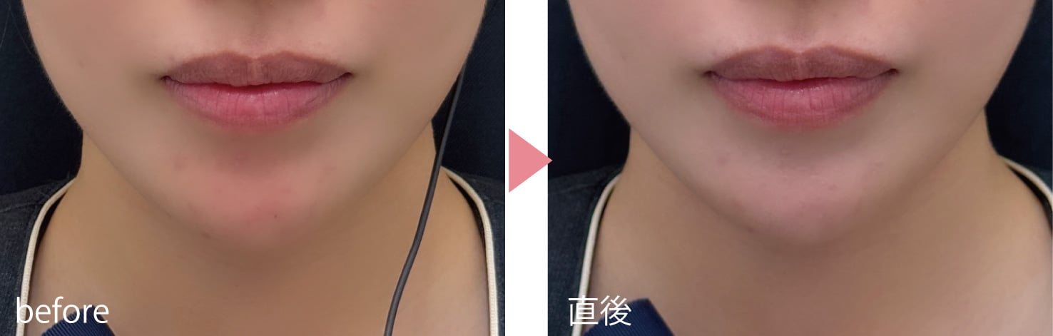 力を入れた時にでる梅干しのようなしわに