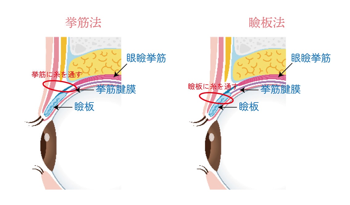違いは「糸をかける位置」