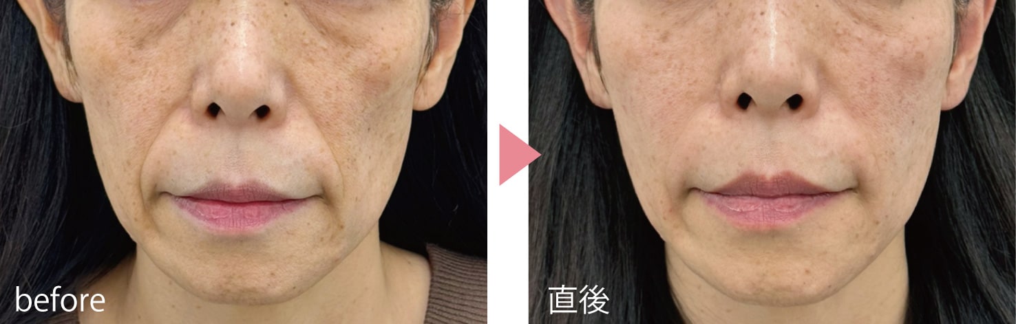 深いしわやくぼみ、ボリューム回復させたい方におすすめの2種