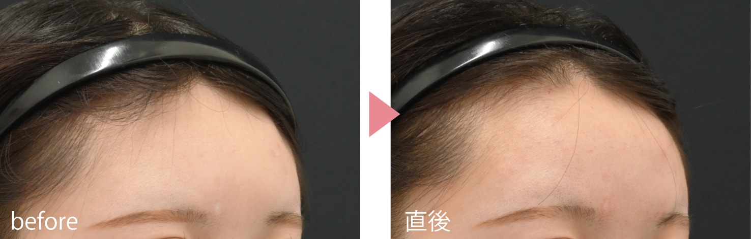 小じわやくぼみの治療向けなのがボルベラXC