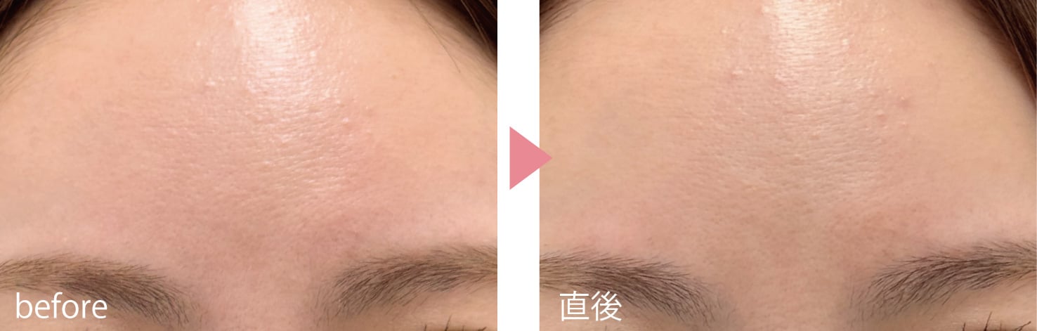 眉毛を上げたときのおでこの横じわに