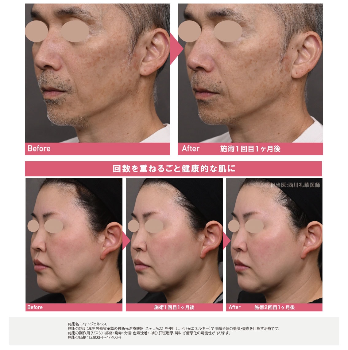フォトジェネシスがおすすめ