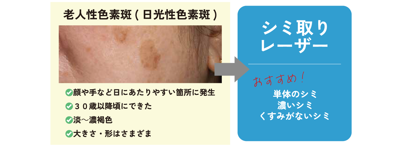 老人色素斑(シミ)