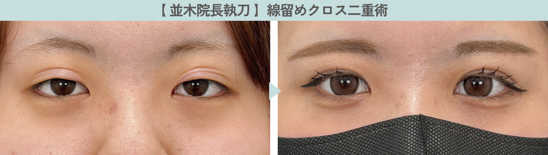 【人気No.2】線留めクロス二重術