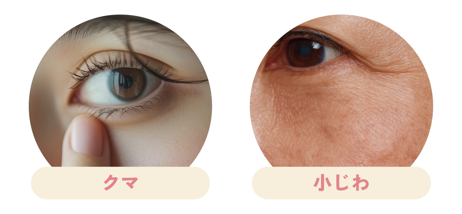 手術なしで目の下の小ジワや凹み、色味改善