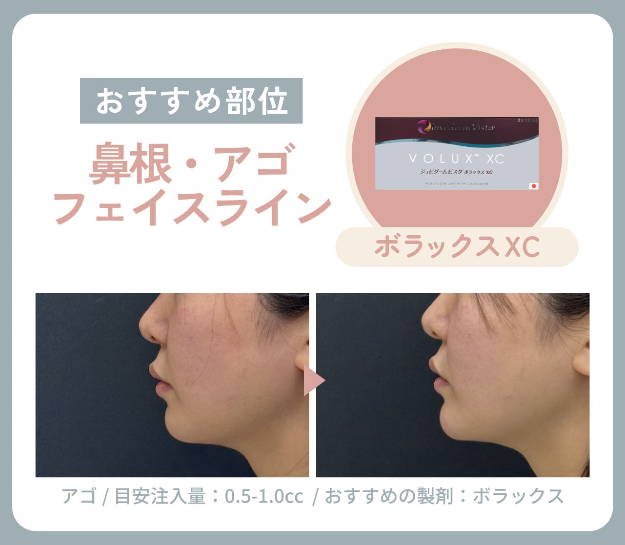 鼻根・アゴ・フェイスライン
