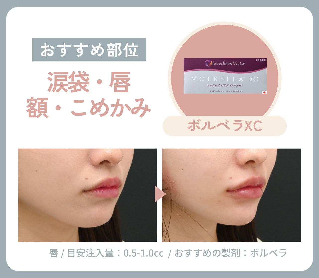 涙袋・唇・頬・こめかみ