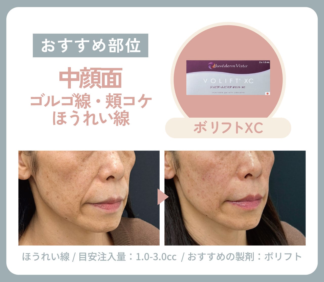 中顔面（ゴルゴ線・頬コケ・ほうれい線）