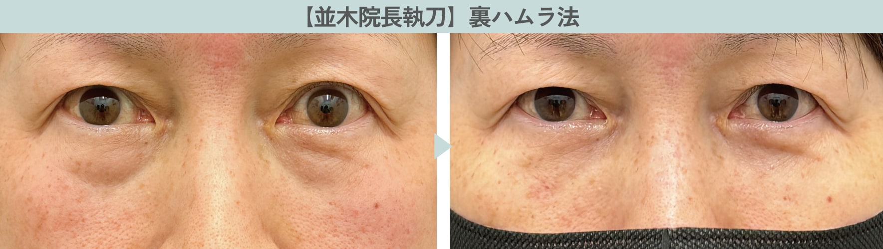「裏ハムラ法」とは