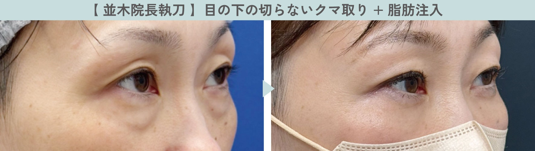 「目の下の切らないクマ取り」とは