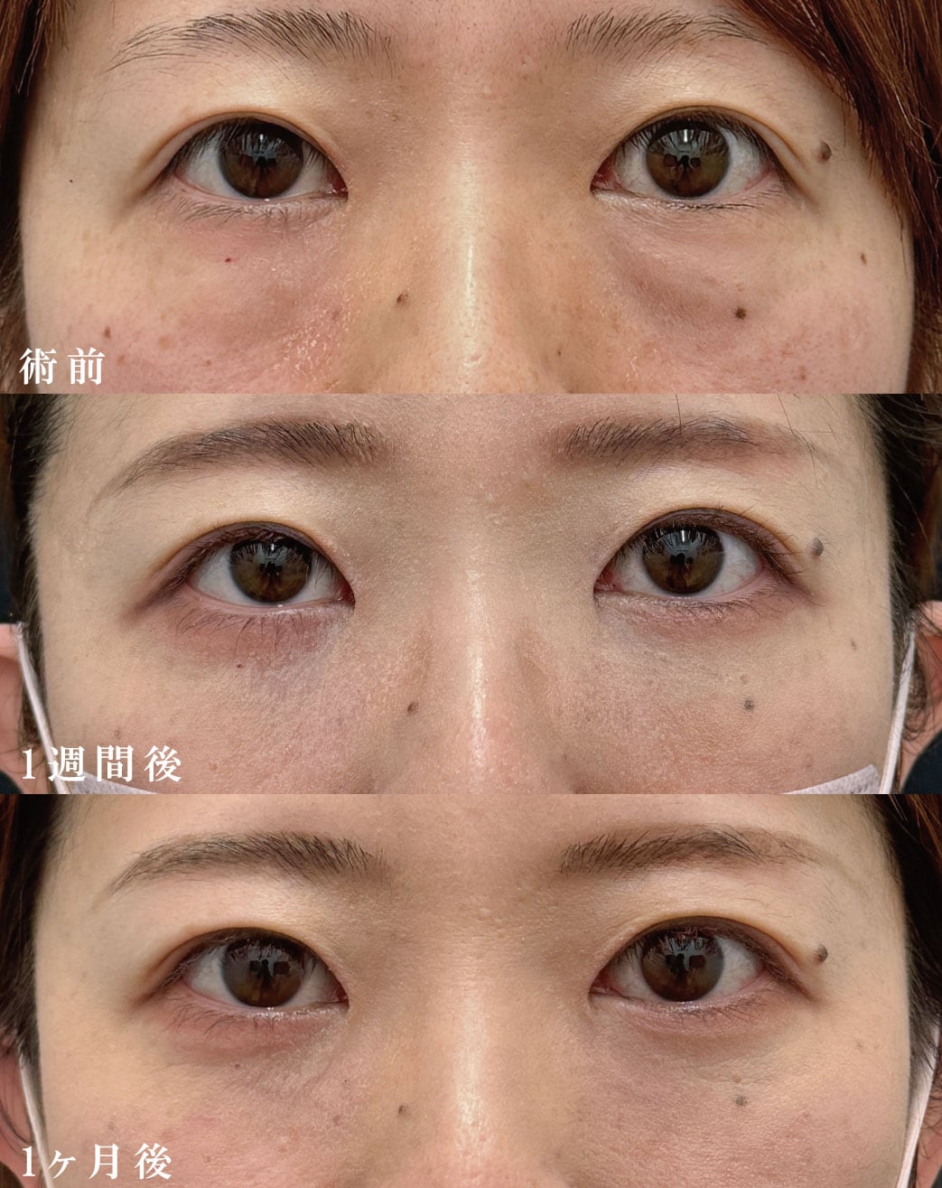 心配な方は【脱脂+脂肪注入】がおすすめ