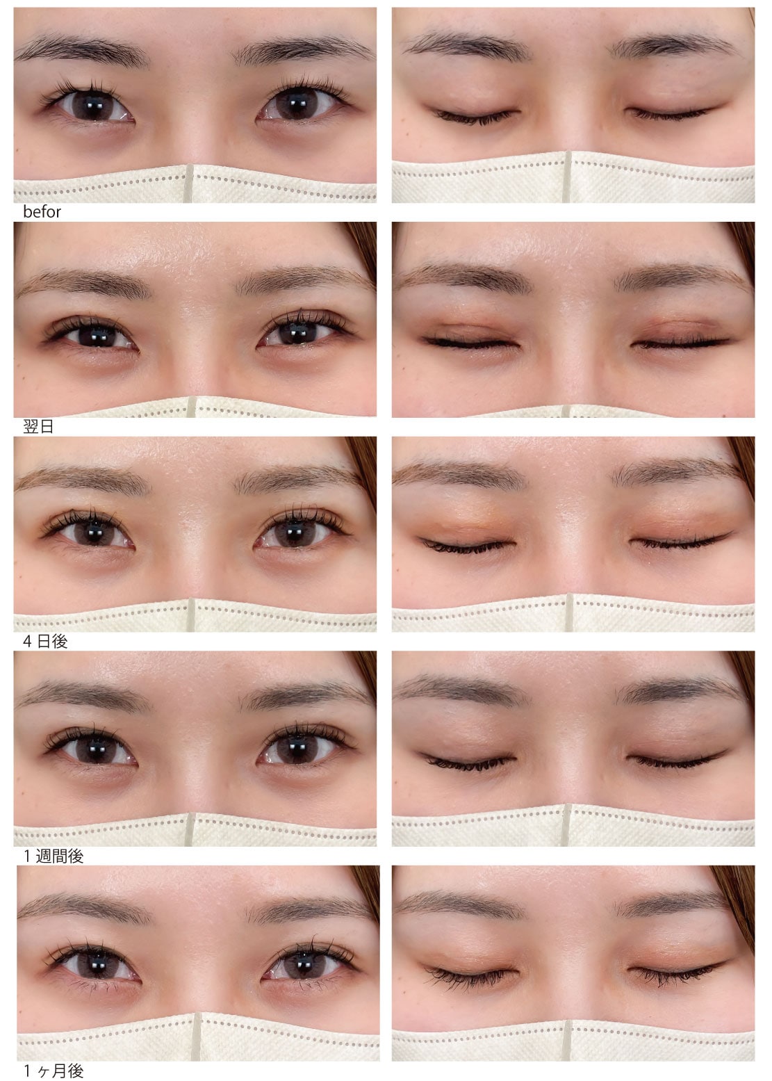 術式はクイックコスメティークダブルNeo