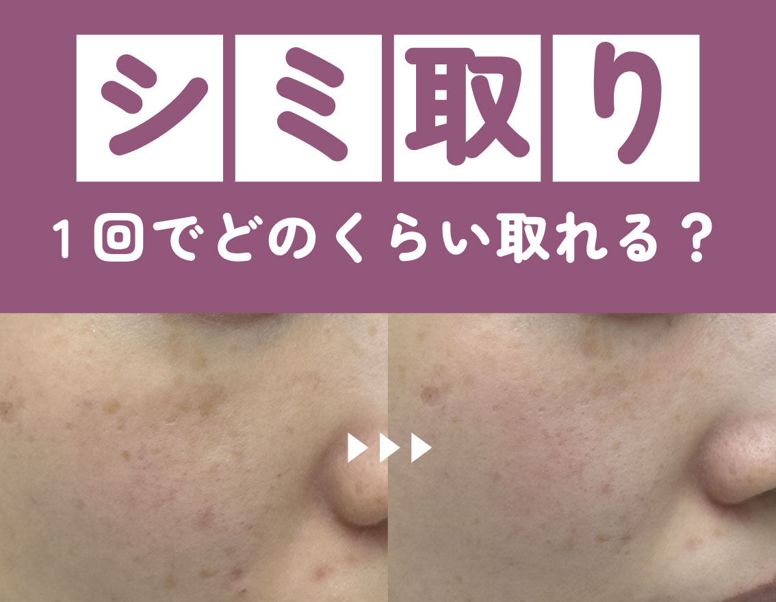 福島でシミ取り治療なら湘南美容クリニック福島院|料金・経過・ケアについて