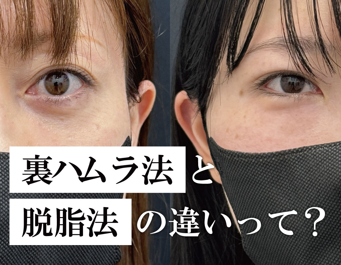 【20%OFFキャンペーン中!】脱脂と裏ハムラの違いって? | 美容のお悩みは湘南美容クリニック福島院