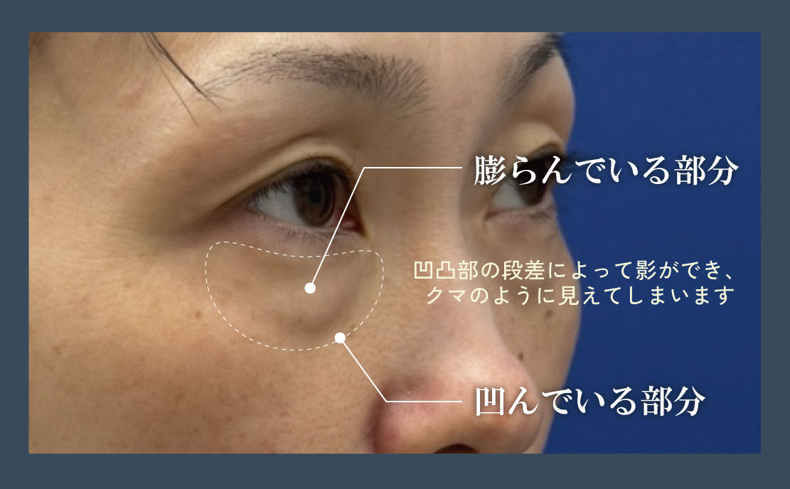 原因は「眼窩脂肪（がんかしぼう）」