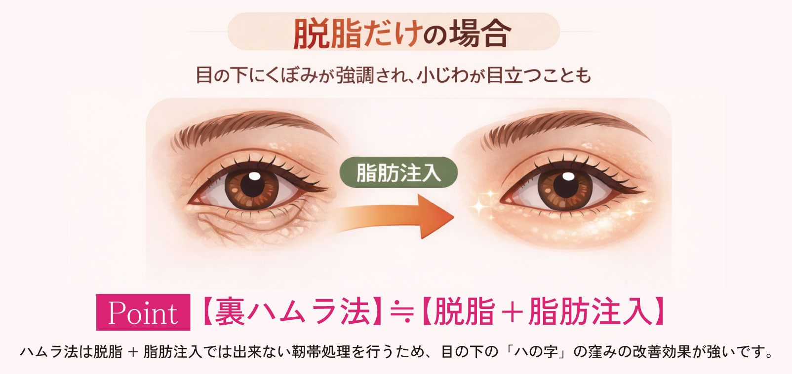 脂肪注入併用がおすすめ