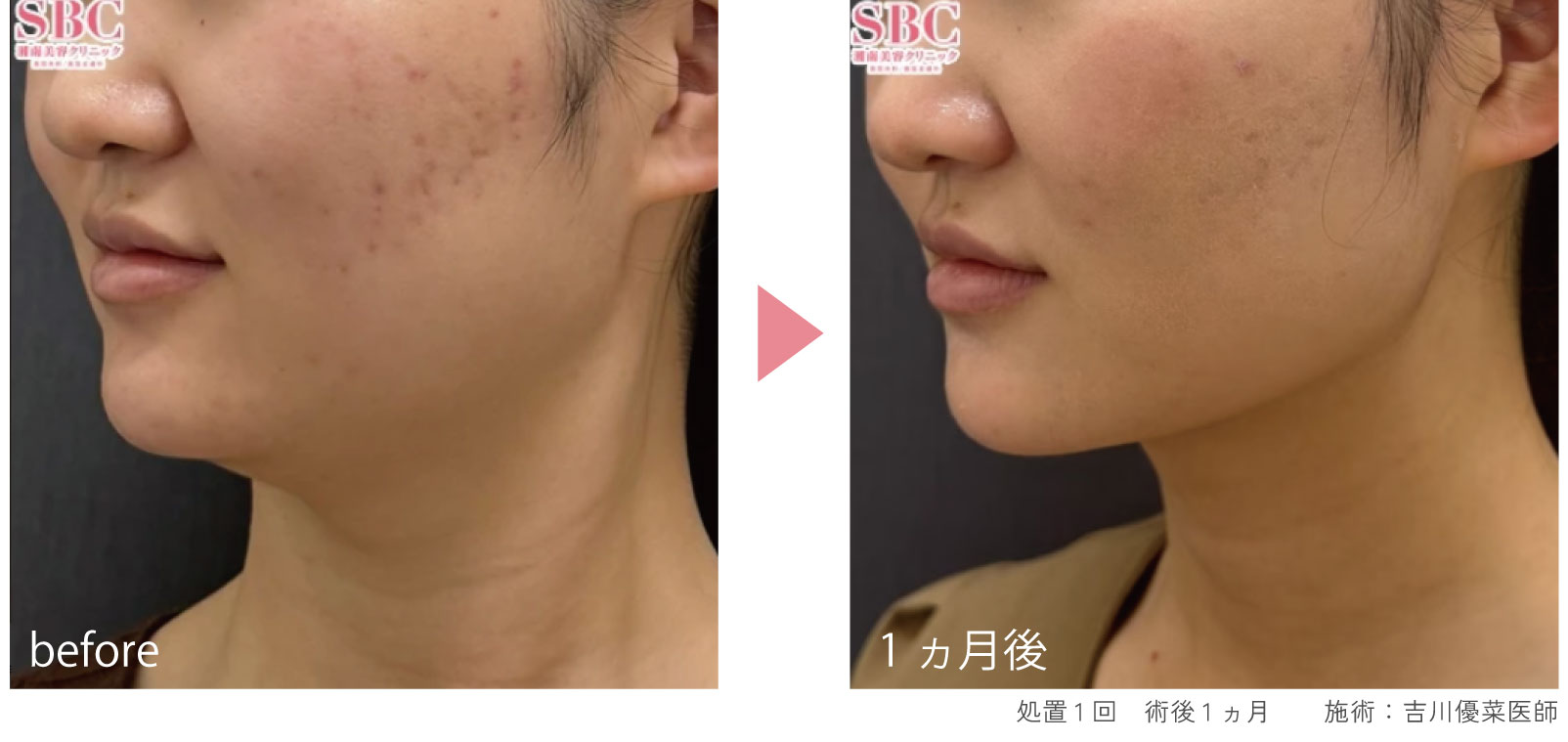 一度の施術でも効果実感！