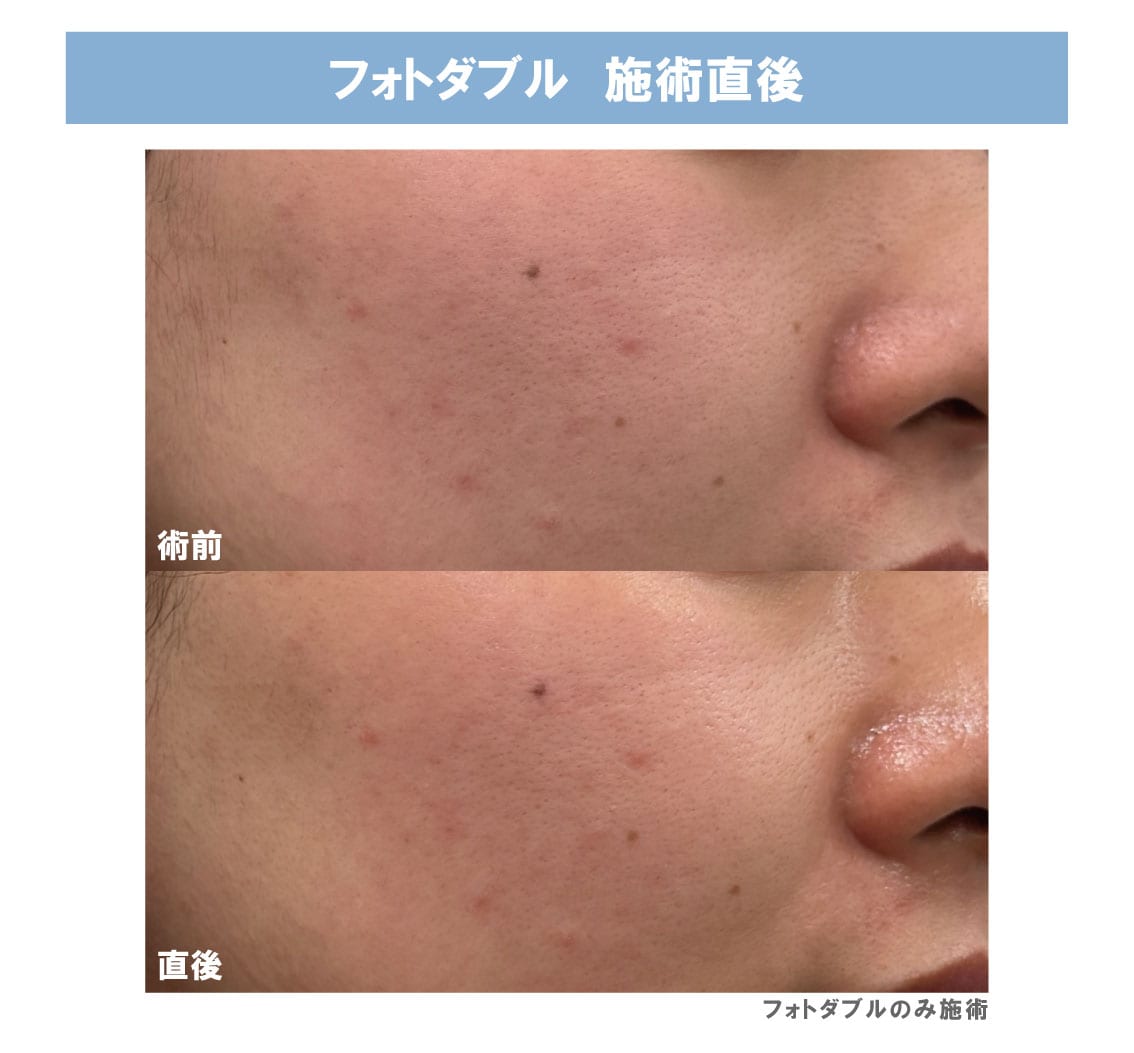 ニキビ】【そばかす】【肌育】ステラM22で美肌GET！【福島院のオススメ