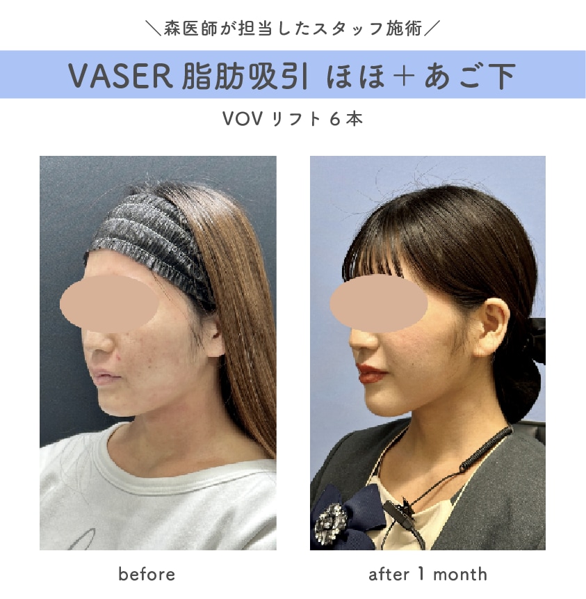 糸リフト＋脂肪吸引