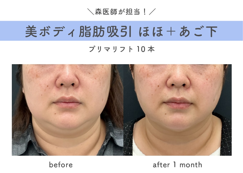 糸リフト＋脂肪吸引