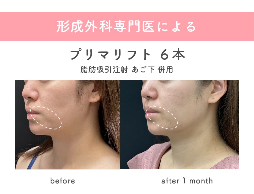 森🌳院長は糸リフトと脂肪吸引の症例件数が多数!