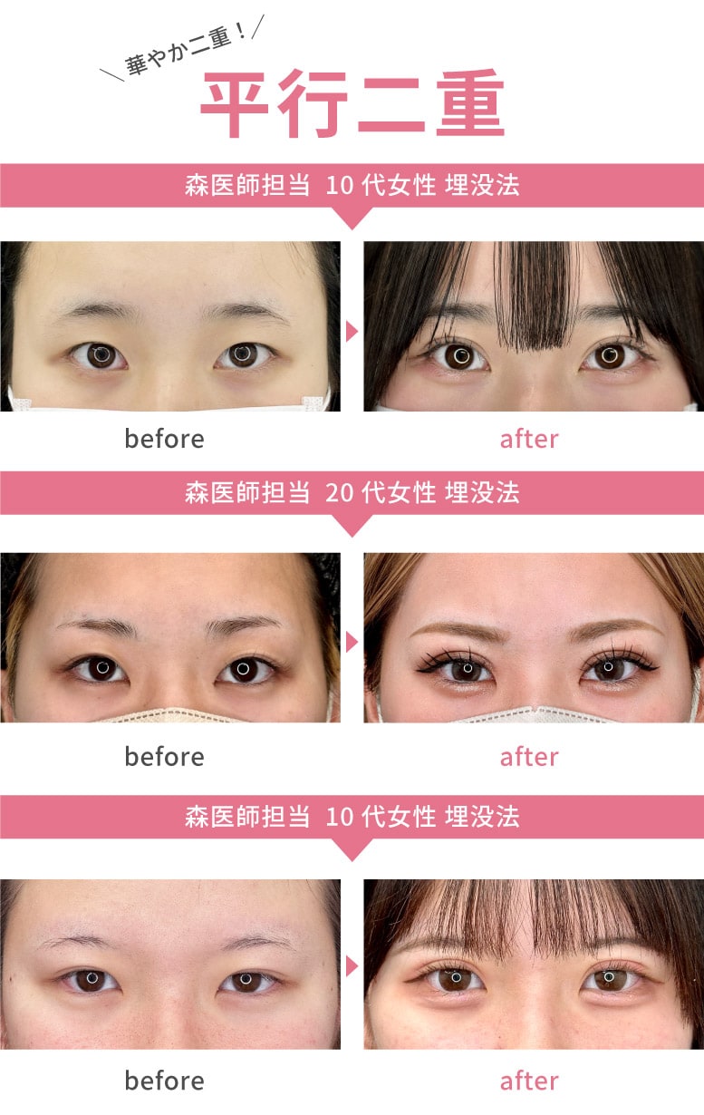 形成外科専門医が行う“二重の種類別”症例写真のご紹介♪