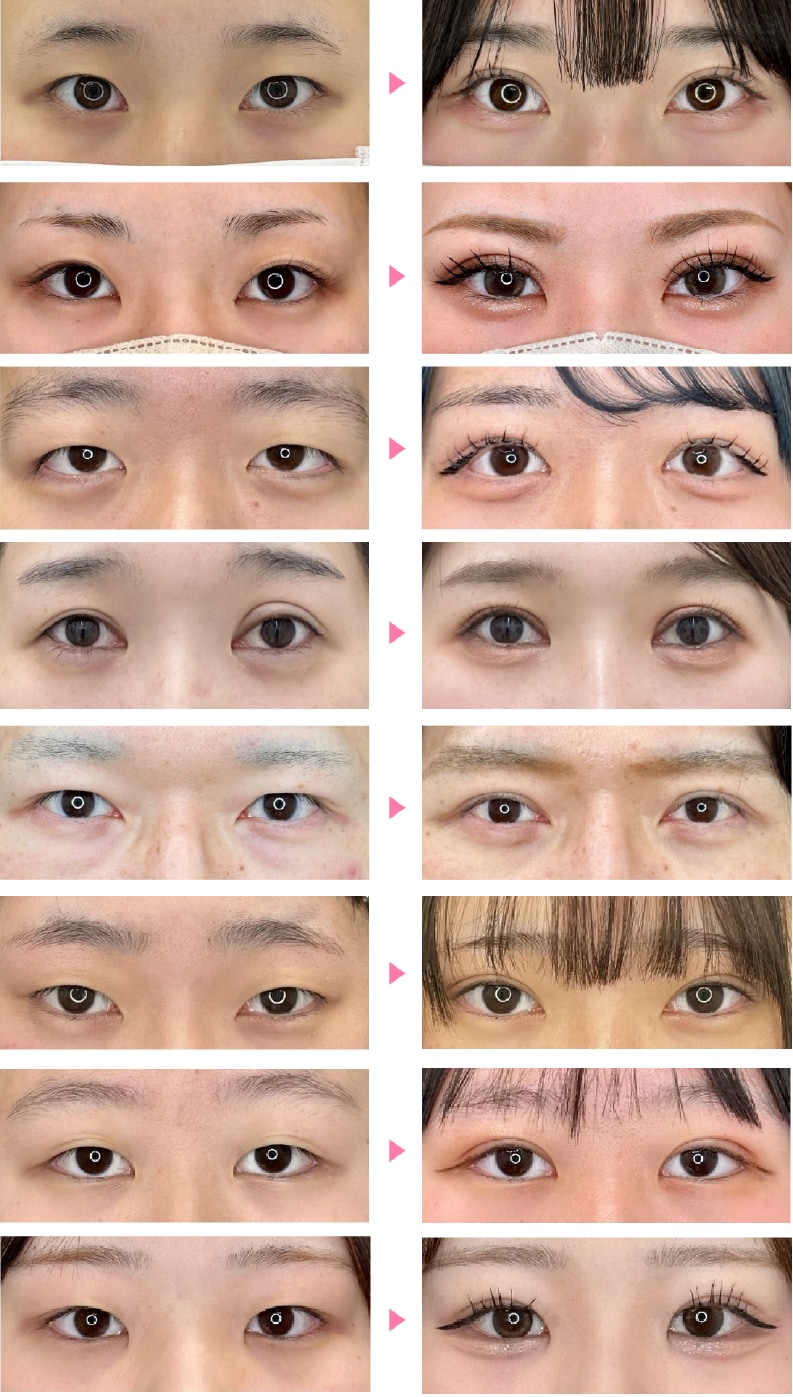形成外科専門医が行う“愛されふたえ術”