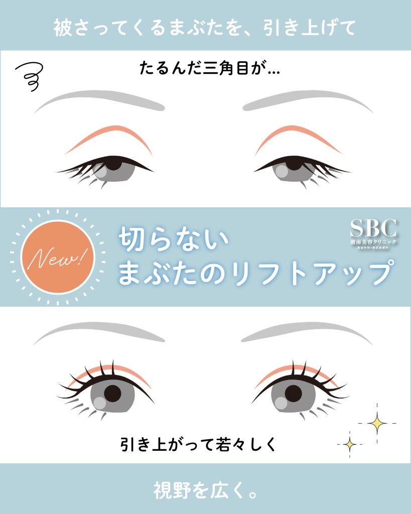 切開なし】たるんだまぶたをリフトアップ！最小限のダウンタイムで改善 
