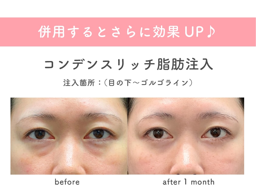 脂肪注入を一緒に受けていただくと効果UP♪