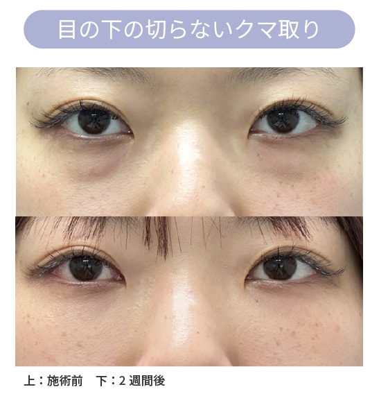 ＼1番スタンダード／目の下の切らないクマ取り